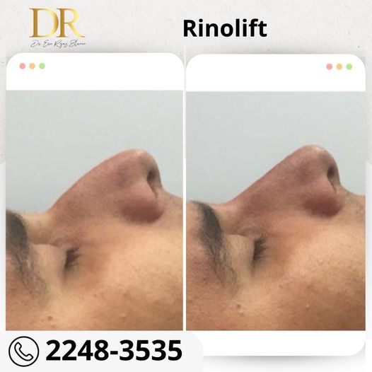 Rinolift es la mejor técnica para mejorar tu perfil.